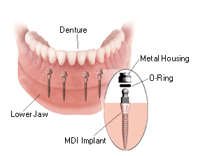 A diagram showing a mini dental implant supported denture