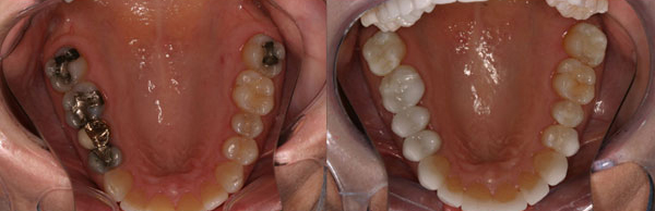Metal-free dentistry is on the rise