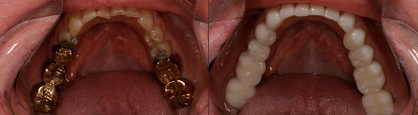 Metal-free dentistry