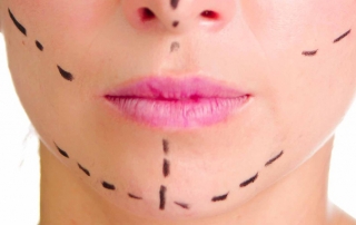 Closeup headshot caucasian woman with dotted lines drawn around face looking into camera, preparing cosmetic surgery