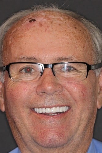 Full face smile of a patient happy with the results for cosmetic dentistry