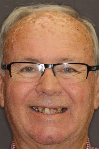 Full face picture of a patient of Beyond Exceptional Dentistry before treatment