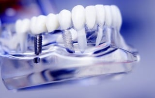 Why Insurance Won't Cover Dental Implants | Hilton Head