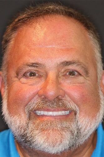 Wide smile of a dental patient of Beyond Exceptional Dentistry after treatment