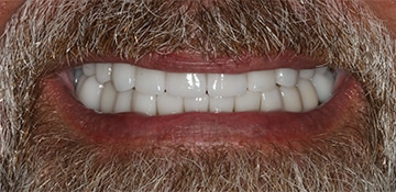 New smile of a patient of Beyond Exceptional Dentistry after treatment