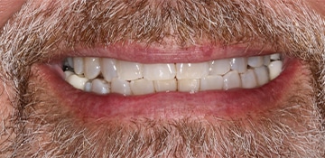 Closeup of a man's smile showing show teeth before treatment with Beyond Exceptional Dentistry