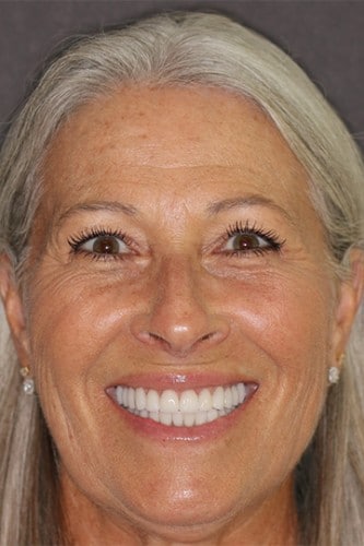 Full face view of a female after cosmetic dentistry