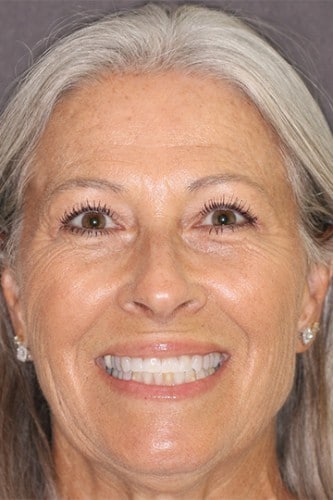 Full face view of a female dental patient of Beyond Exceptional Dentistry before treatment