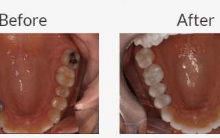 Why Not Keep Metal Fillings?