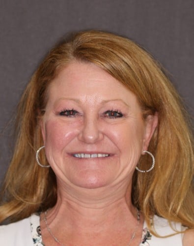 Before cosmetic dental work completed by Beyond Exceptional Dentistry