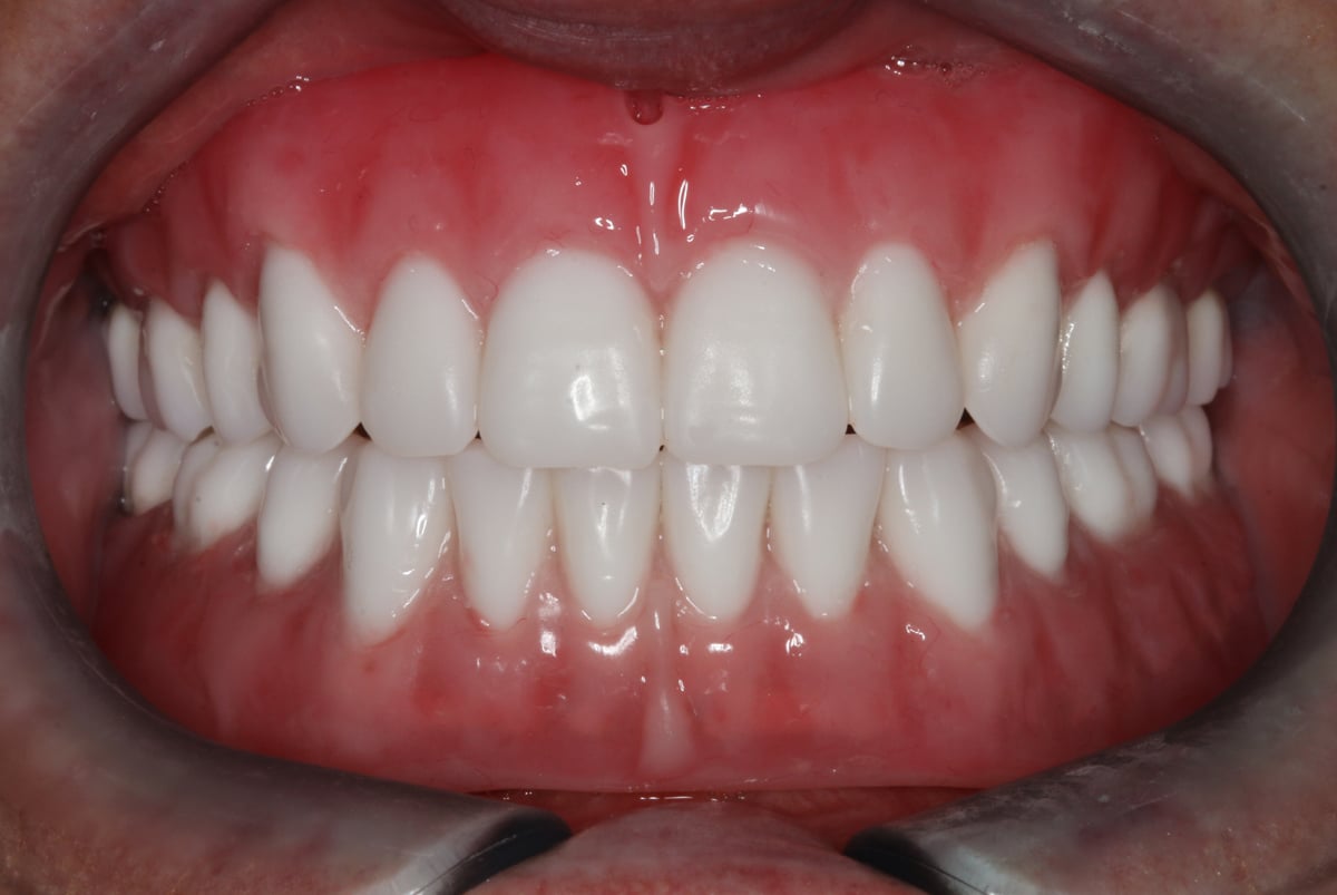 After cosmetic dental work completed by Beyond Exceptional Dentistry