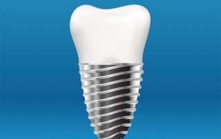 A strong dental implant