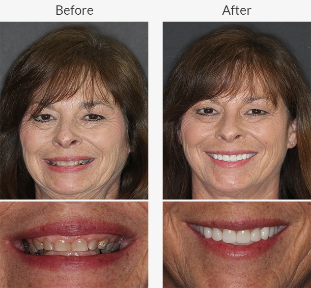 Dental patient of Beyond Exceptional Dentistry shows off before and after treatment smiles