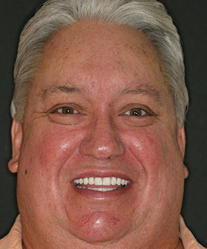 Closeup of a male patient of Beyond Exceptional Dentistry after treatment Closeup of a male patient of Beyond Exceptional Dentistry after treatment