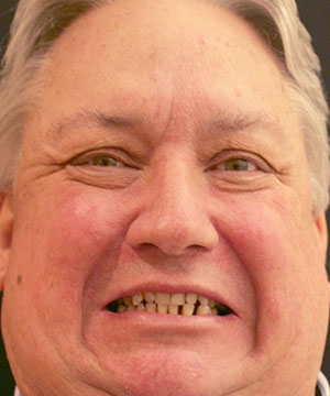 Closeup of a male patient of Beyond Exceptional Dentistry before treatment Closeup of a male patient of Beyond Exceptional Dentistry before treatment