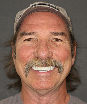 Closeup of a male dental patient's smile after cosmetic treatment with Beyond Exceptional Dentistry Closeup of a male dental patient's smile after cosmetic treatment with Beyond Exceptional Dentistry