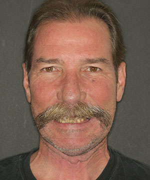 Closeup of a male dental patient before treatment with Beyond Exceptional Dentistry Closeup of a male dental patient before treatment with Beyond Exceptional Dentistry