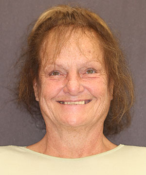Smile of a female patient of Beyond Exceptional Dentistry before treatment Smile of a female patient of Beyond Exceptional Dentistry before treatment