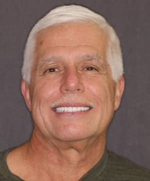 An after image of a male dental patient of Beyond Exceptional Dentistry An after image of a male dental patient of Beyond Exceptional Dentistry