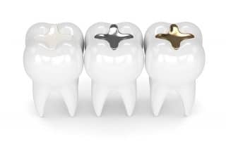 3 large teeth showing stages of fillings