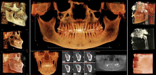 3D dental implant x-ray