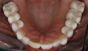 close up of bottom set of teeth after cosmetic dental work