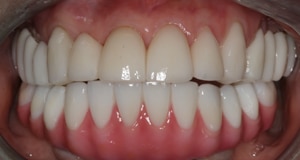 After cosmetic dental work completed by Beyond Exceptional Dentistry closeup