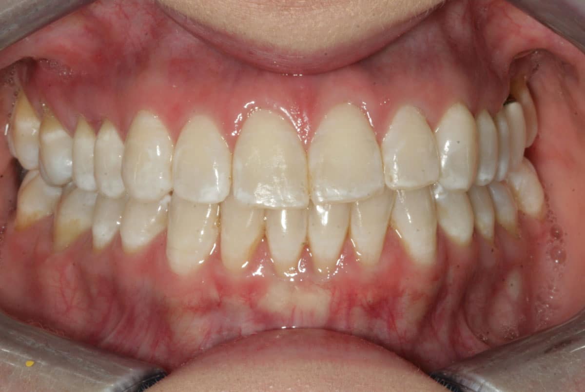 before a cosmetic dental procedure by Beyond Exceptional Dentistry closeup