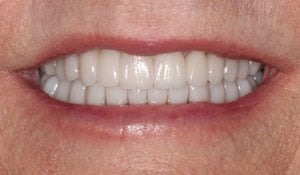 After a cosmetic dental procedure by Beyond Exceptional Dentistry closeup