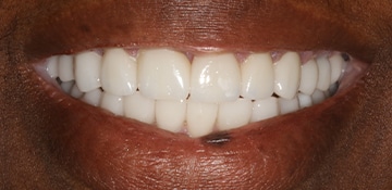 Closeup of female dental patients smile after treatment